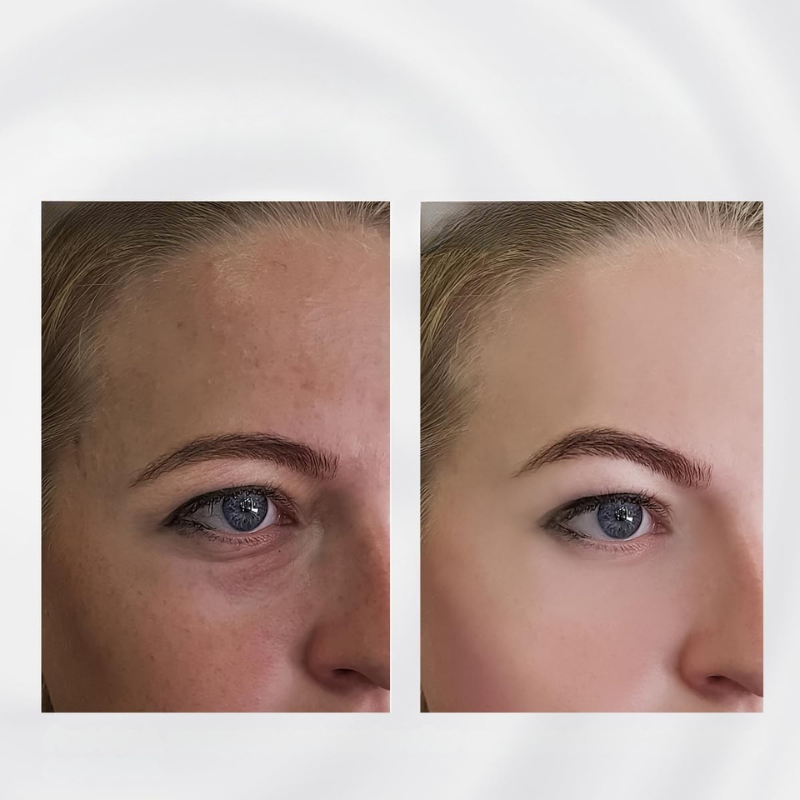 Skin firming before and after