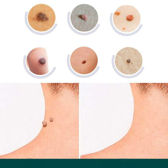 Gentle Skin Tag and Blemish Patches for Discreet Daily Spot Care